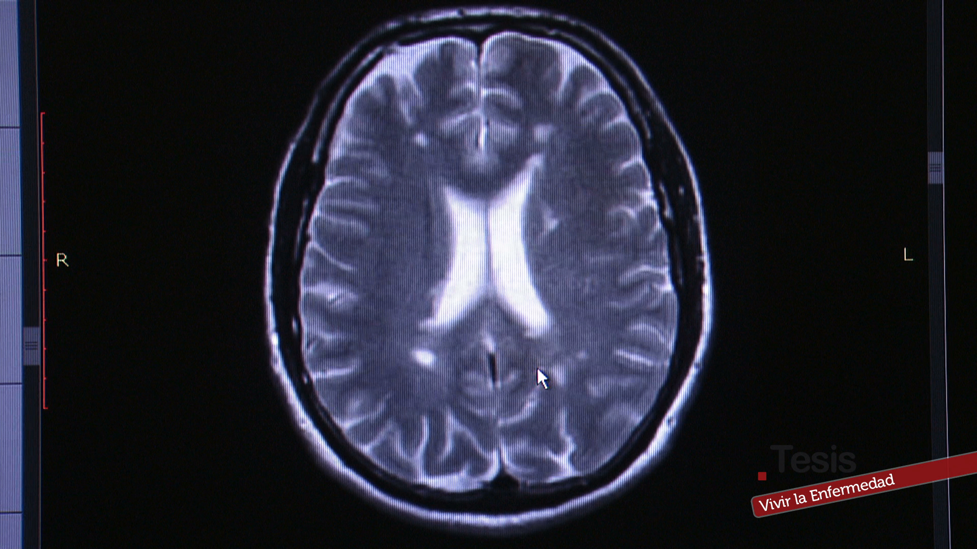 Enfermedades neurodegenerativas