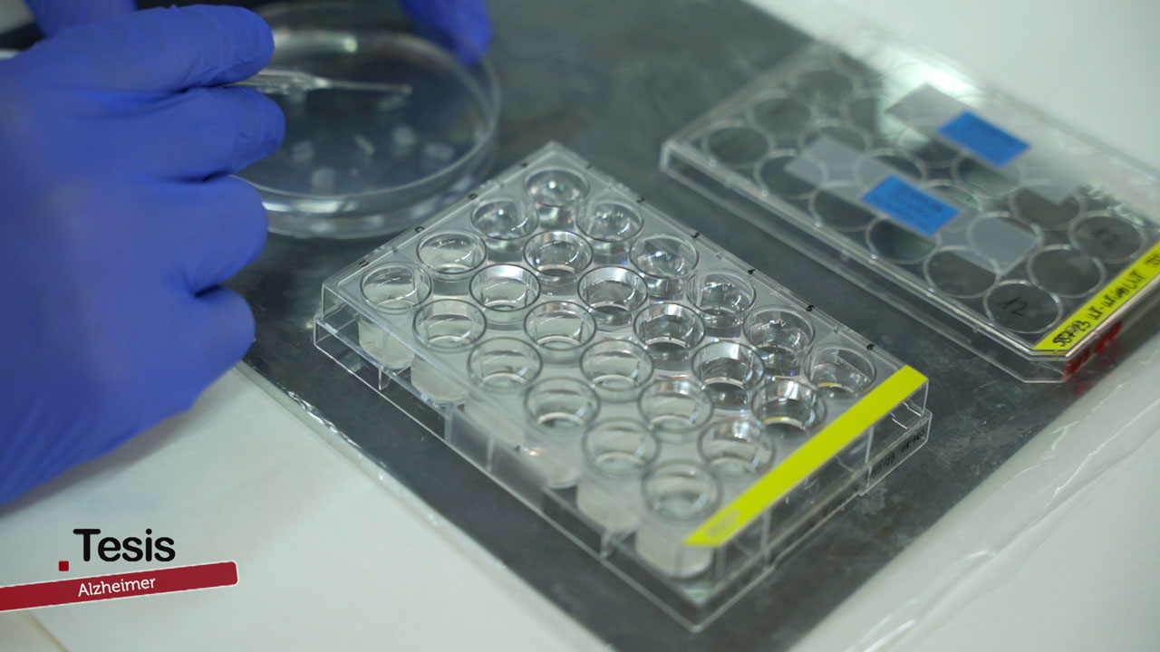 Por qué el alzhéimer avanza de forma distinta en el cerebro humano.