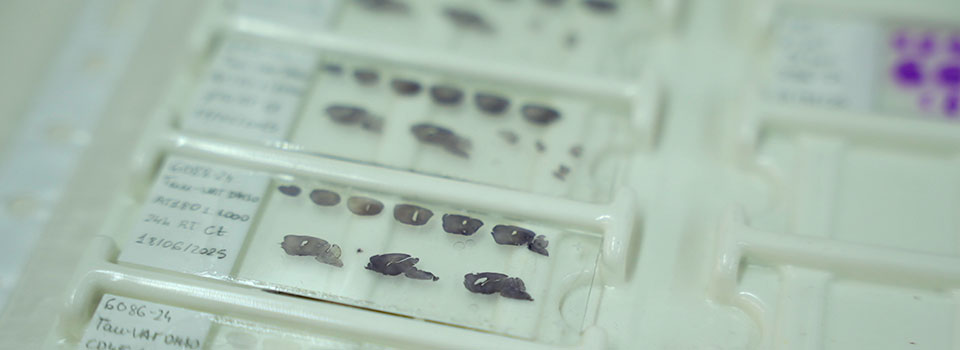 Por qué el alzhéimer avanza de forma distinta en el cerebro humano.