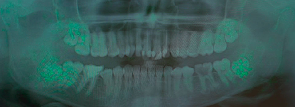 LAENet: inteligencia artificial para estimar la edad y proteger a menores no acompañados